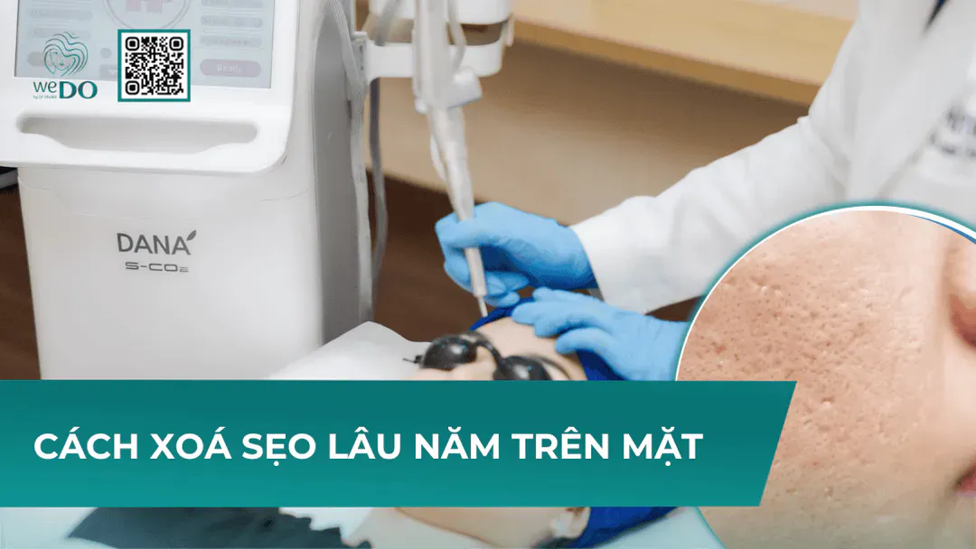 Cách xoá sẹo lâu năm trên mặt mọi người nên biết