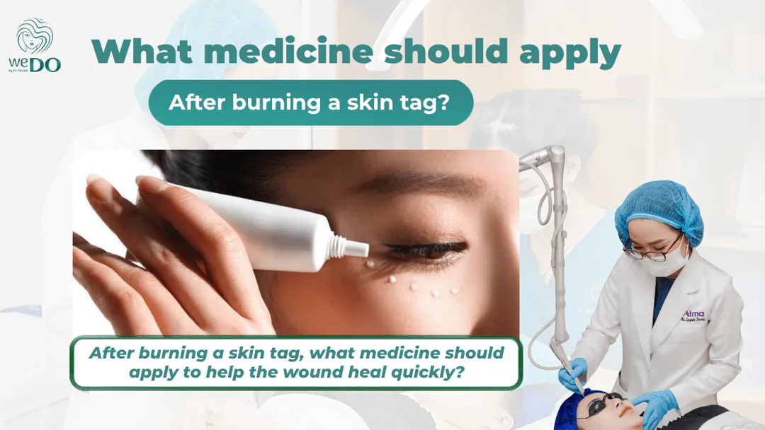 After burning a skin tag, what medicine should apply to help the wound heal quickly?