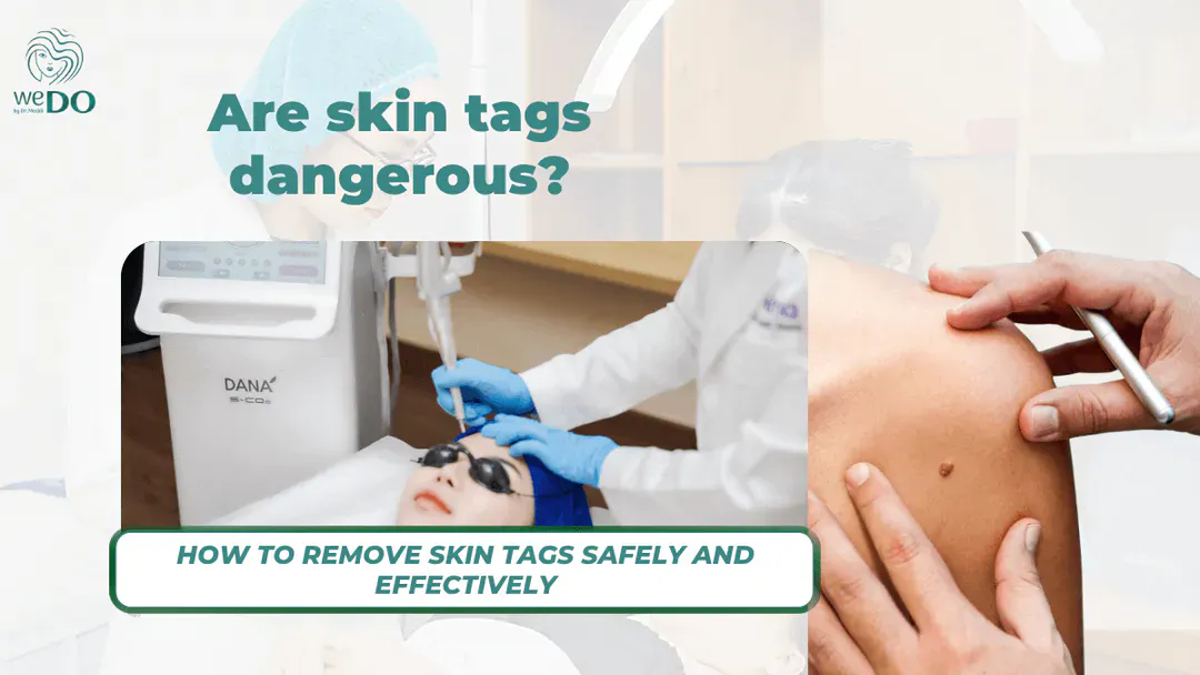 Are skin tags dangerous? How to remove skin tags