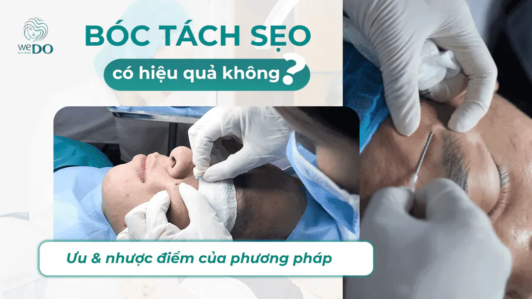 Bóc tách sẹo rỗ có hiệu quả không? Giá bao nhiêu?