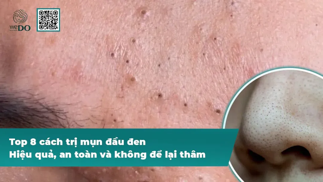 Top 8 cách trị mụn đầu đen hiệu quả, an toàn và không để lại thâm