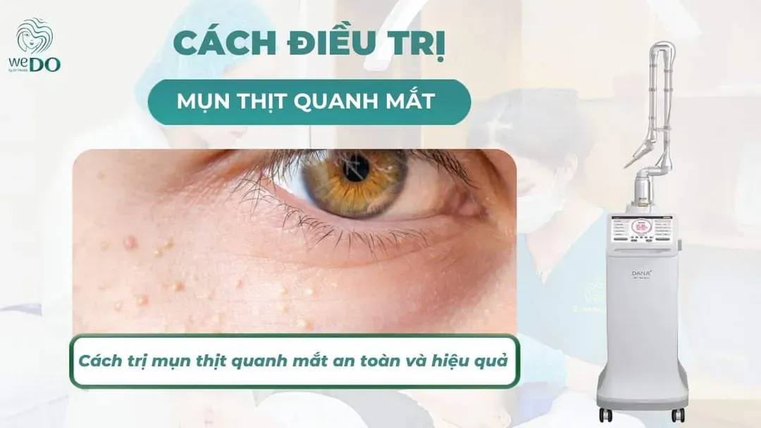 Cách trị mụn thịt quanh mắt an toàn, hiệu quả cao