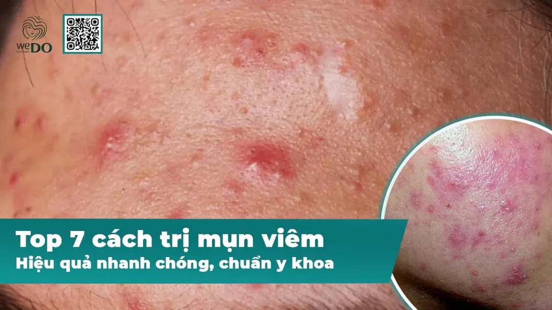 Top 7 cách trị mụn viêm hiệu quả nhanh chóng, chuẩn y khoa