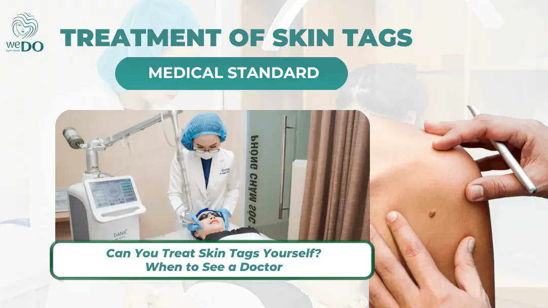 Can You Treat Skin Tags Yourself? When to See a Doctor