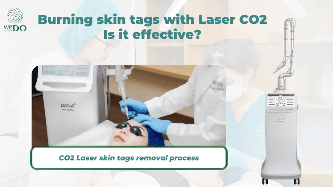 Is CO2 laser effective in burning skin tags?