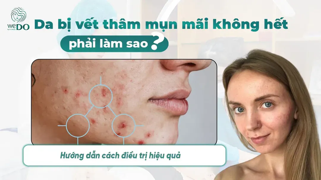 Da bị vết thâm mụn mãi không hết phải làm sao? Hướng dẫn cách điều trị hiệu quả