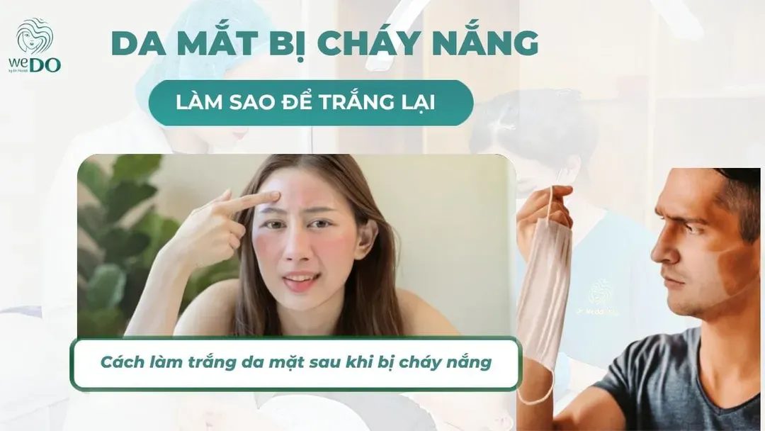 Da mặt bị cháy nắng làm sao để trắng lại?