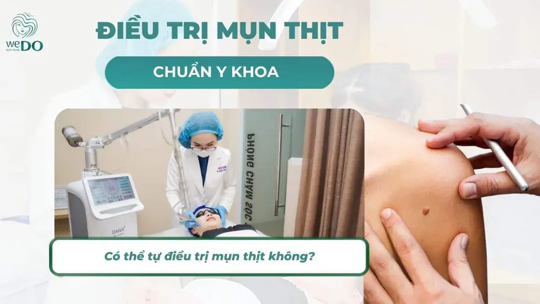 Có thể tự điều trị mụn thịt không? Khi nào nên đến bác sĩ