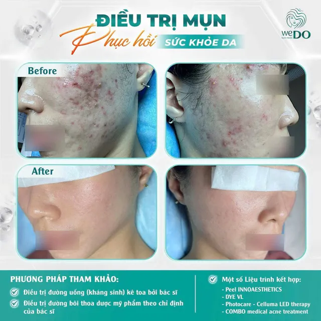 Điều trị mụn viêm, đỏ nặng - say bye làn da lúc nào cũng đỏ