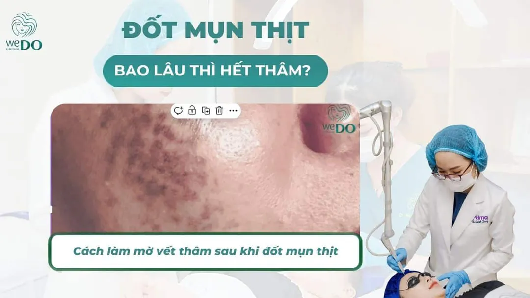 Đốt mụn thịt bao lâu thì hết thâm? Cách giúp da hồi phục nhanh chóng