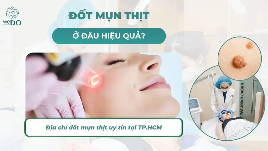 Đốt mụn thịt ở đâu? Địa chỉ đốt mụn thịt uy tín tại TP.HCM