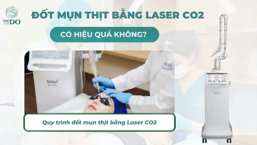 Đốt mụn thịt bằng laser CO2 có hiệu quả không?