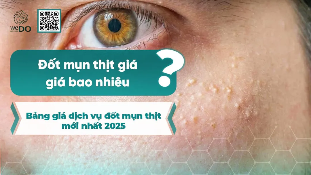 Bảng giá dịch vụ đốt mụn thịt mới nhất 2026