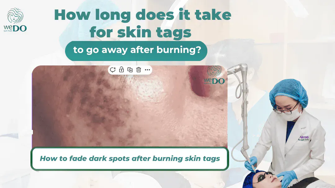 How long does it take for skin tags to go away after burning? How to help skin recover quickly