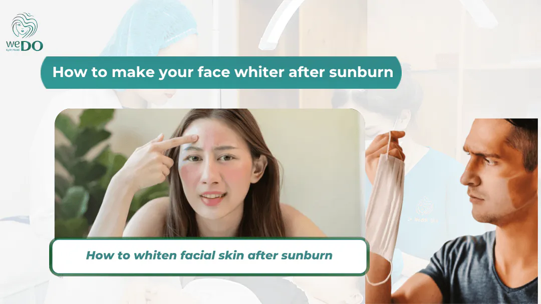 How to whiten sunburned face?