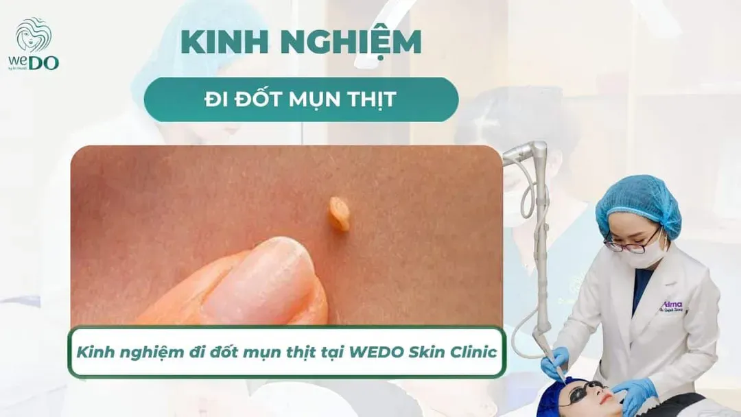 Kinh nghiệm đi đốt mụn thịt tại WEDO Skin Clinic và những điều cần lưu ý