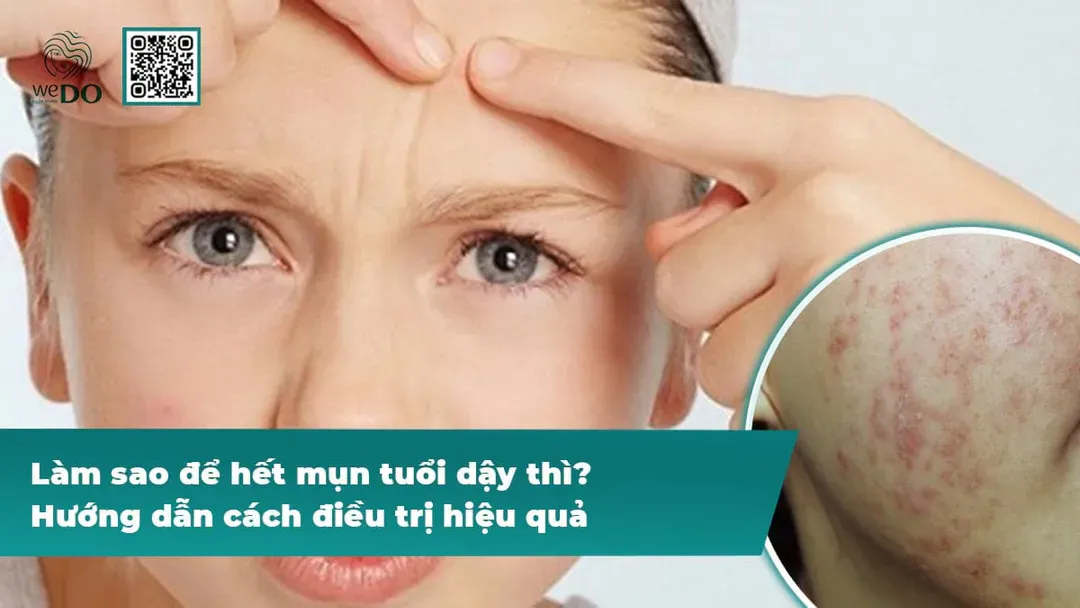 Làm sao để hết mụn tuổi dậy thì? Hướng dẫn cách điều trị hiệu quả