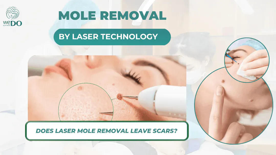 Does laser mole removal leave scars?