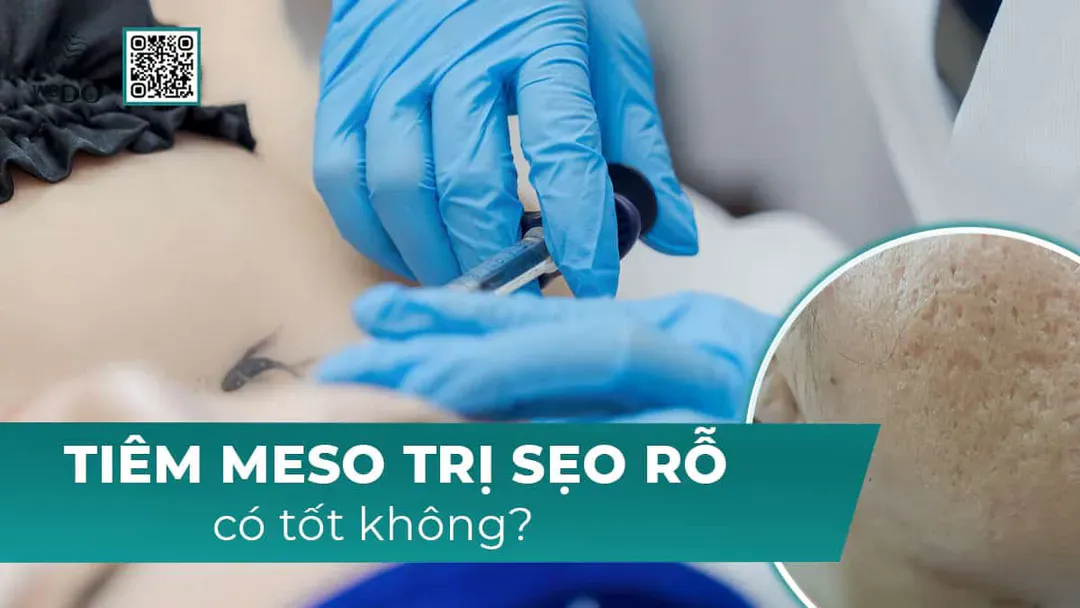 Mesotherapy trị sẹo