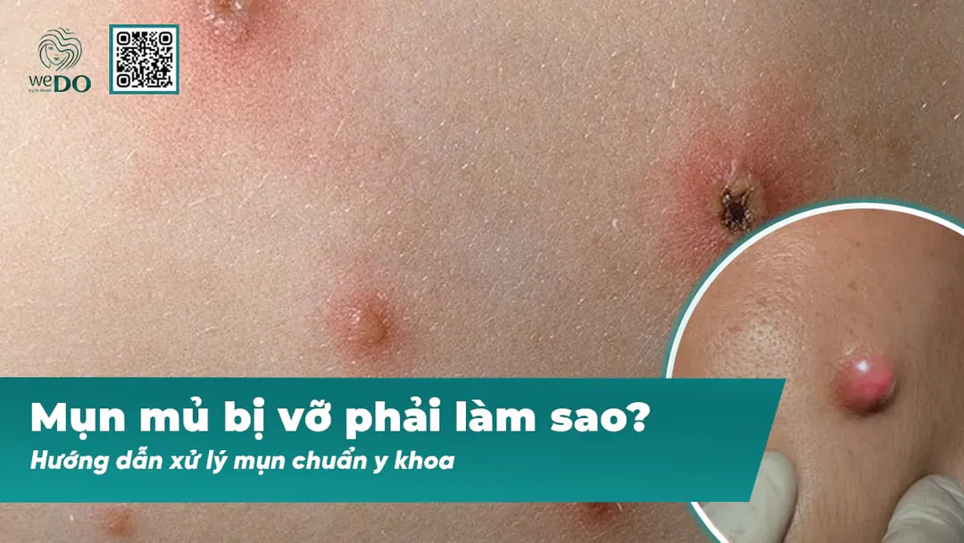 Mụn mủ bị vỡ phải làm sao? Hướng dẫn xử lý mụn chuẩn y khoa
