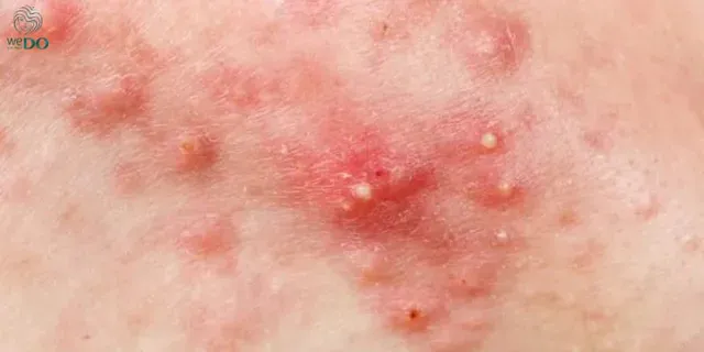 Mụn mủ là một vết mụn chứa dịch trắng hoặc vàng được hình thành nhờ vào việc tích tụ lượng dầu thừa hoặc bị bít tắc lỗ chân lông trên da mặt