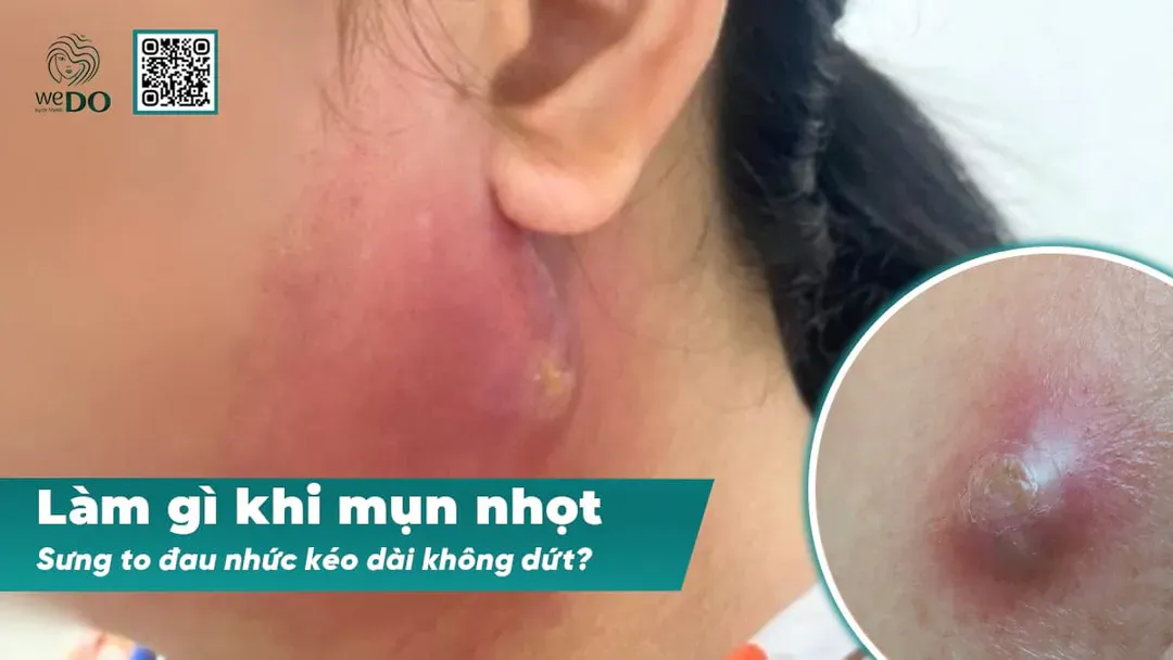 Làm gì khi mụn nhọt sưng to đau nhức kéo dài không dứt?
