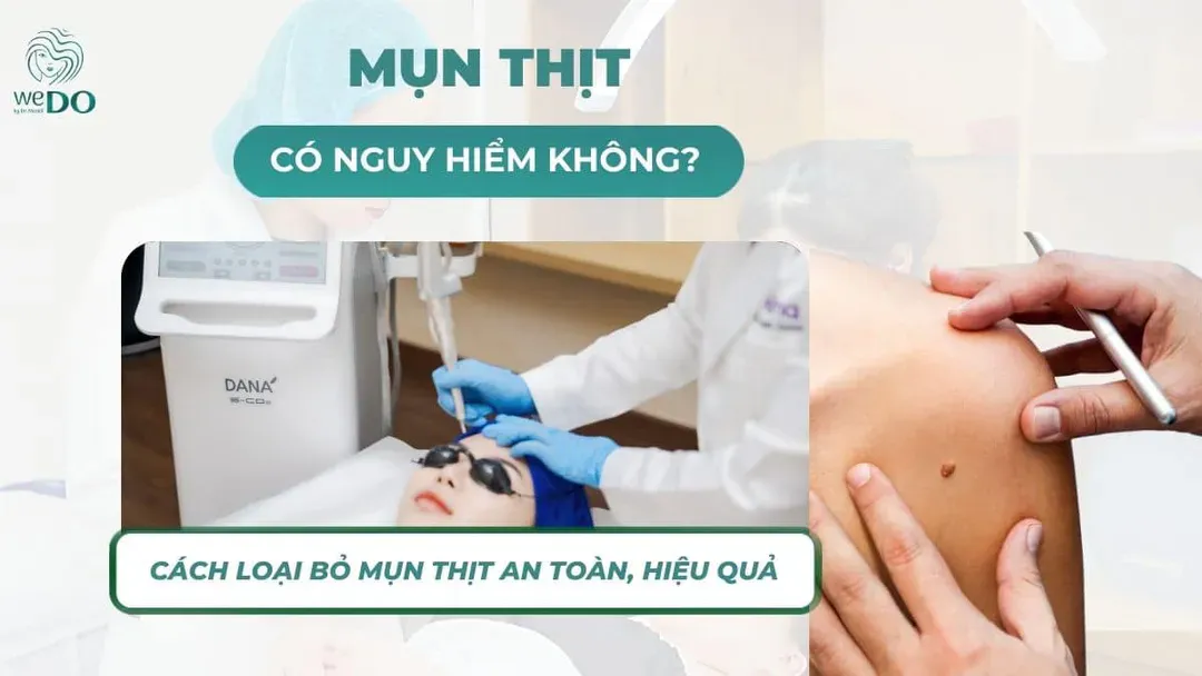 Mụn thịt có nguy hiểm không? Cách loại bỏ mụn thịt