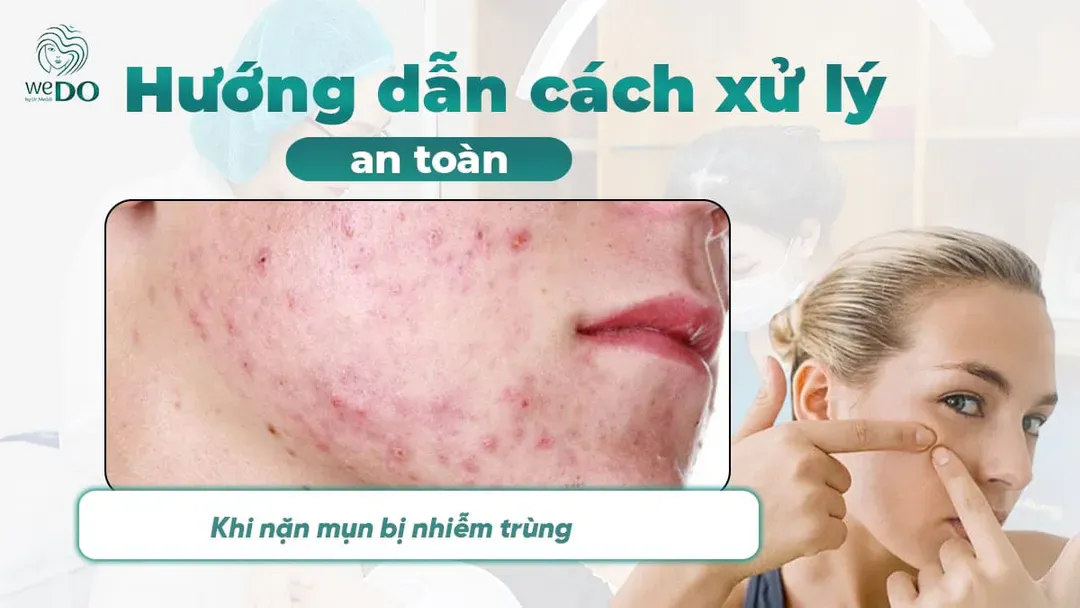 Hướng dẫn xử lý nặn mụn bị nhiễm trùng an toàn và không để lại sẹo