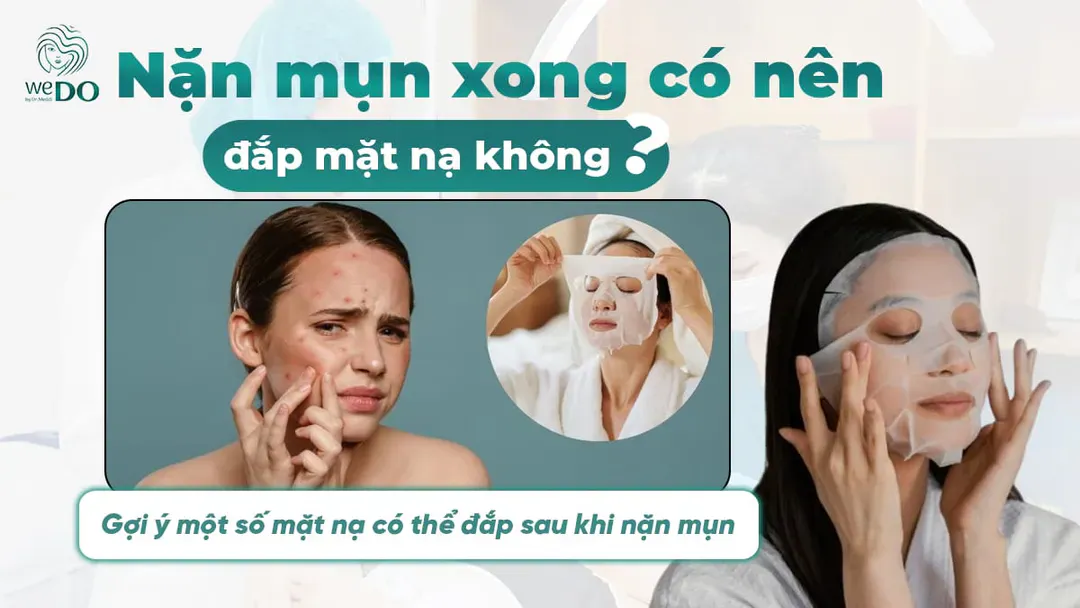 Nặn mụn xong có nên đắp mặt nạ không?