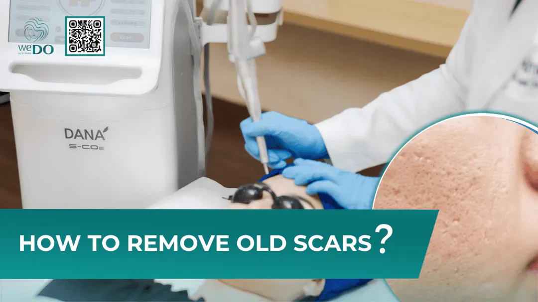 How to remove old scars?