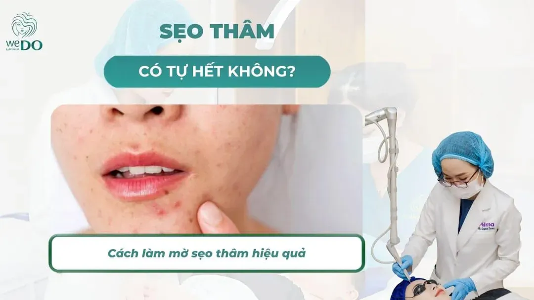 Sẹo thâm có tự hết không? Cách làm mờ sẹo thâm hiệu quả