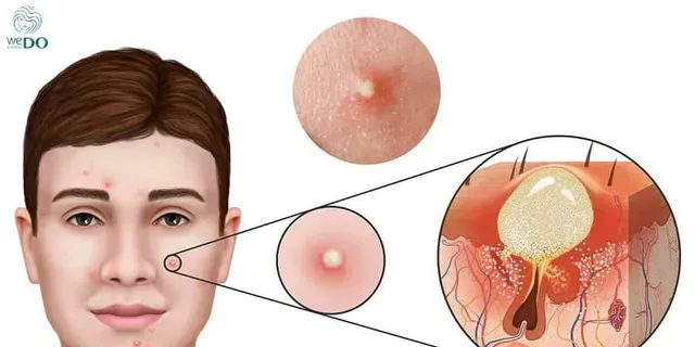 Miếng dán mụn chỉ tác động trên bề mặt da, hút dịch từ các nốt mụn đã hình thành, nhưng không giải quyết được nguyên nhân gốc rễ