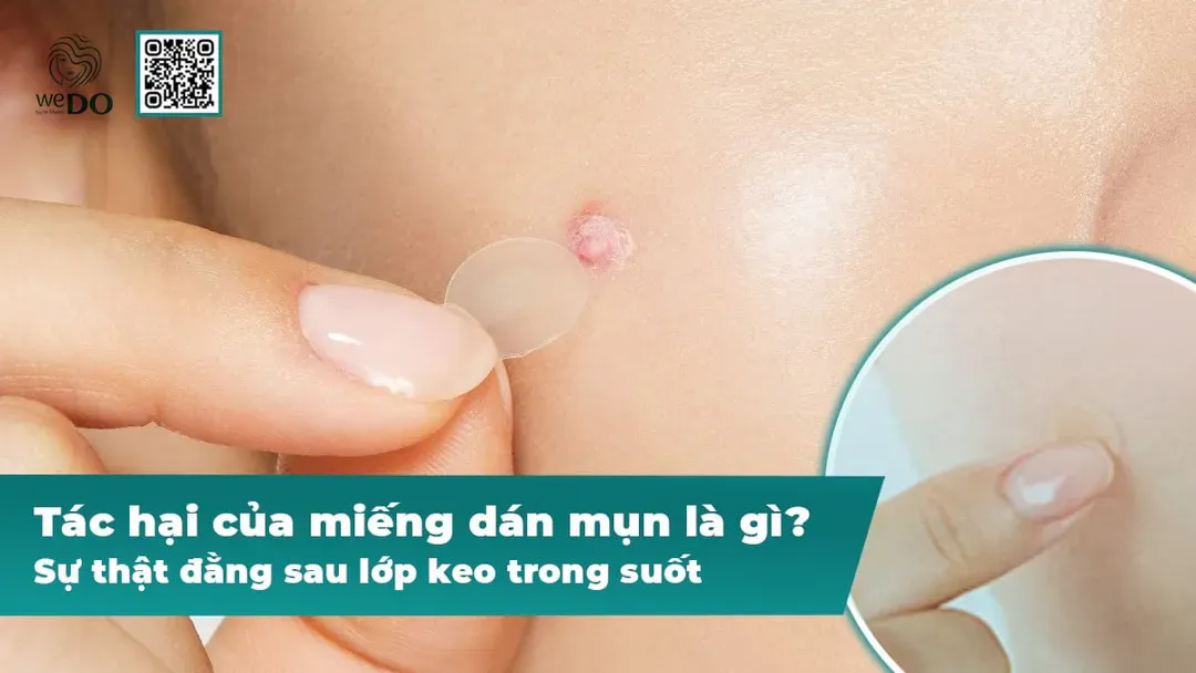 Tác hại của miếng dán mụn là gì? Sự thật đằng sau lớp keo trong suốt