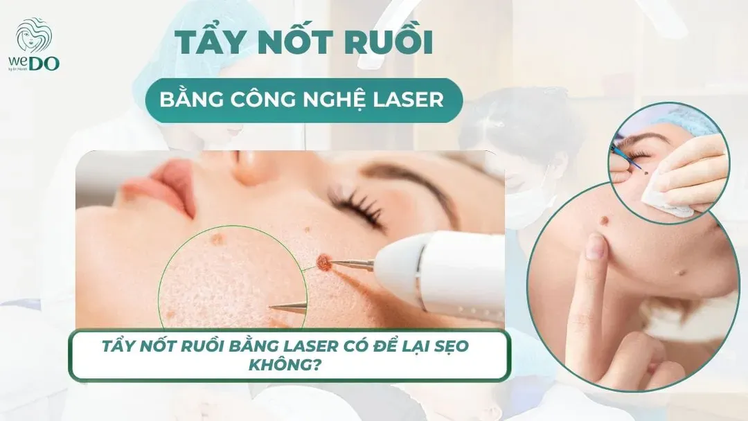 Tẩy nốt ruồi bằng laser có để lại sẹo không?