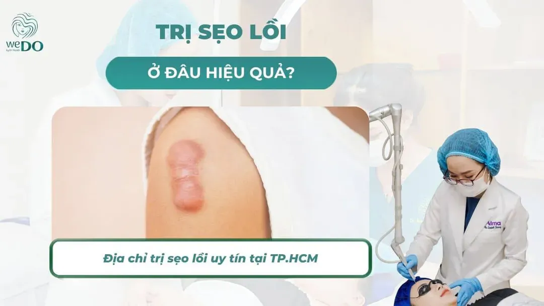Trị sẹo lồi ở đâu hiệu quả? Địa chỉ trị sẹo lồi uy tín tại TP.HCM