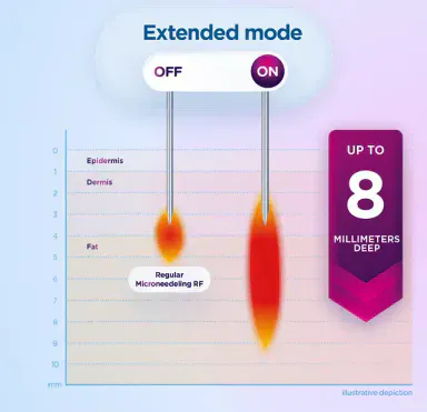 RF needling extend mode