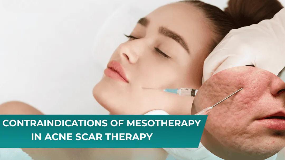 CONTRAINDICATIONS OF MESOTHERAPY IN ACNE SCAR THERAPY