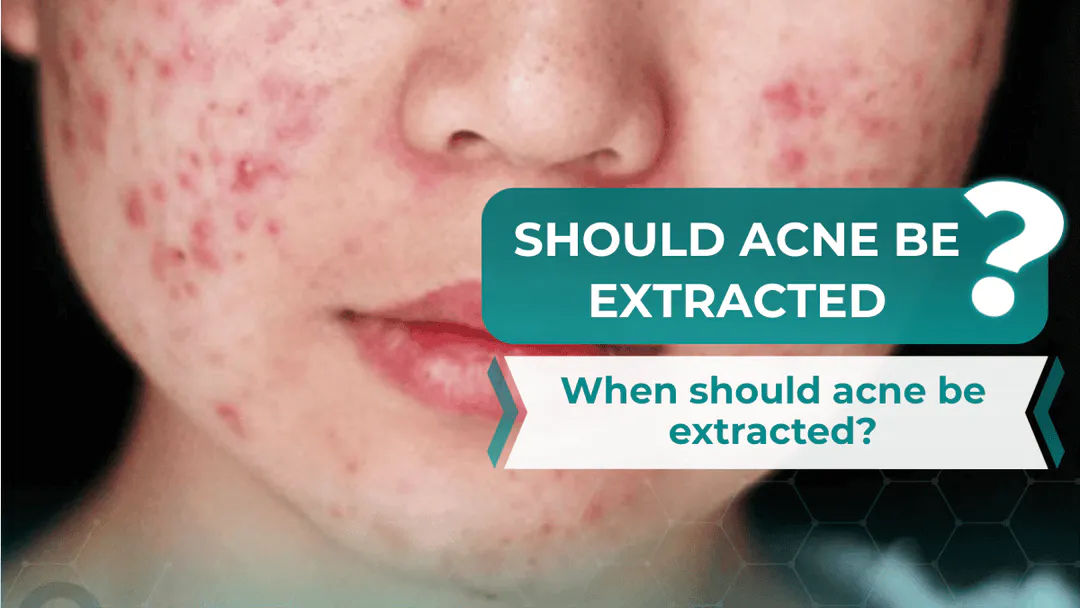 Should Acne Be Extracted and When Is the Right Time?