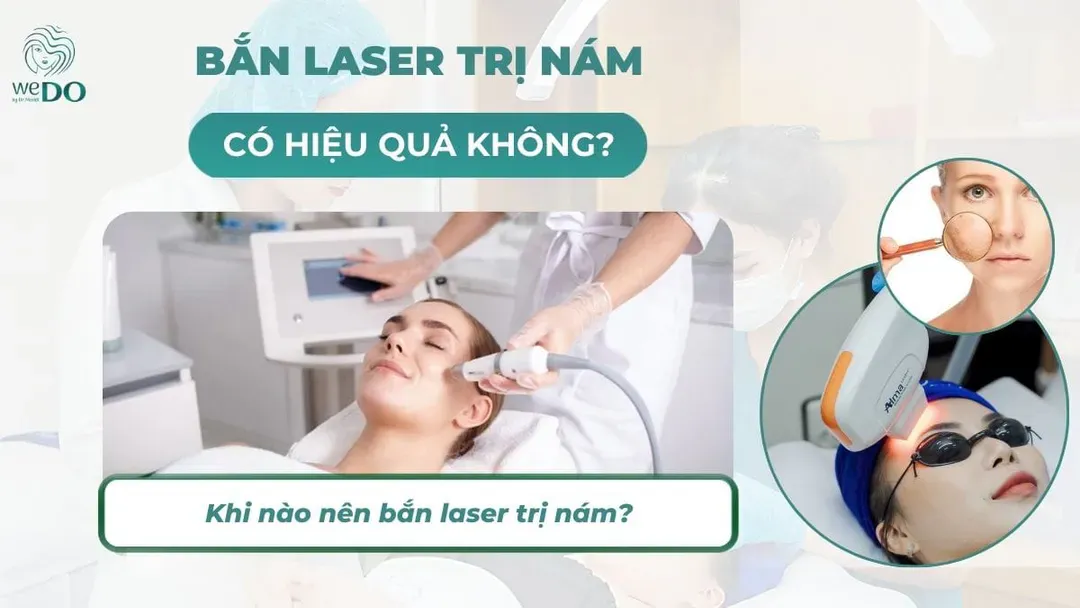 Bắn laser trị nám có hiệu quả không? Khi nào nên thực hiện?