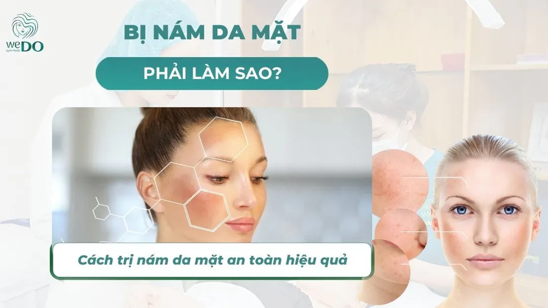 Bị nám da mặt phải làm sao? Cách trị nám da mặt an toàn hiệu quả