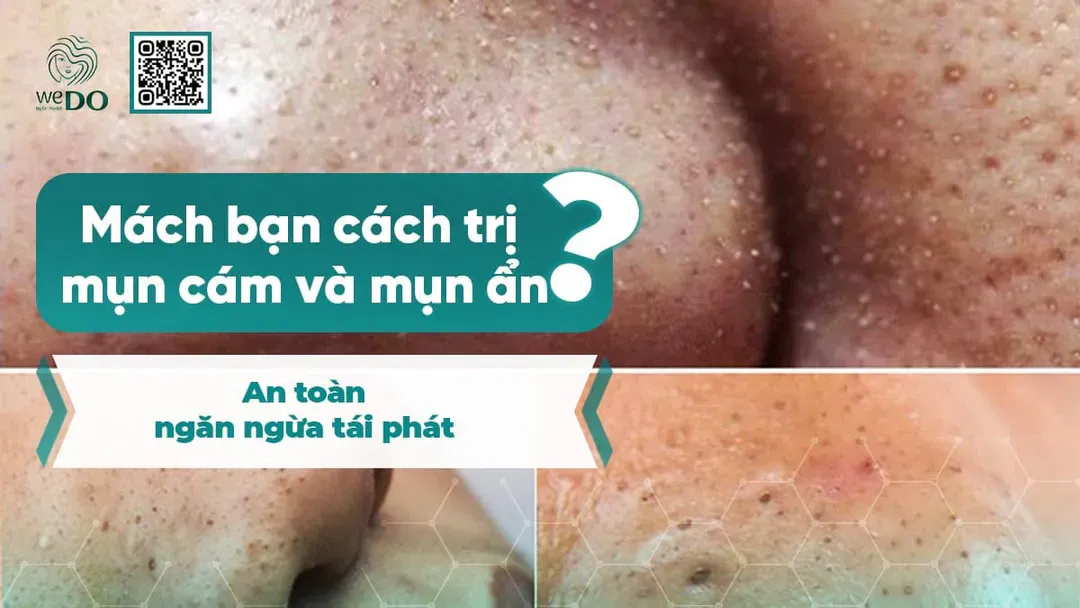 Mách bạn cách trị mụn cám và mụn ẩn an toàn, ngăn ngừa tái phát