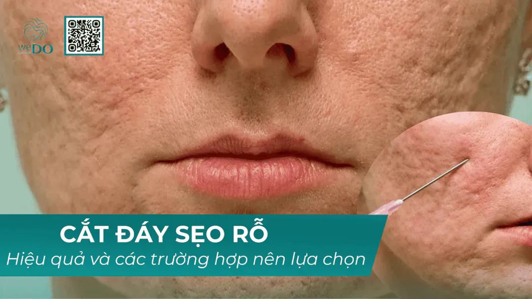 Cắt đáy sẹo rỗ – Hiệu quả và các trường hợp nên lựa chọn