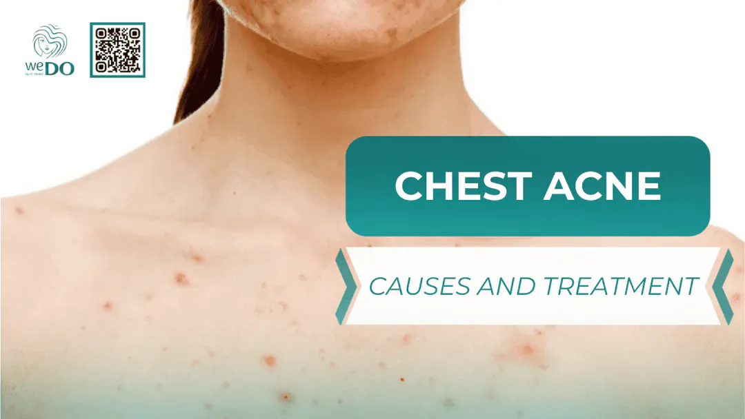 Causes and Management of Chest Acne
