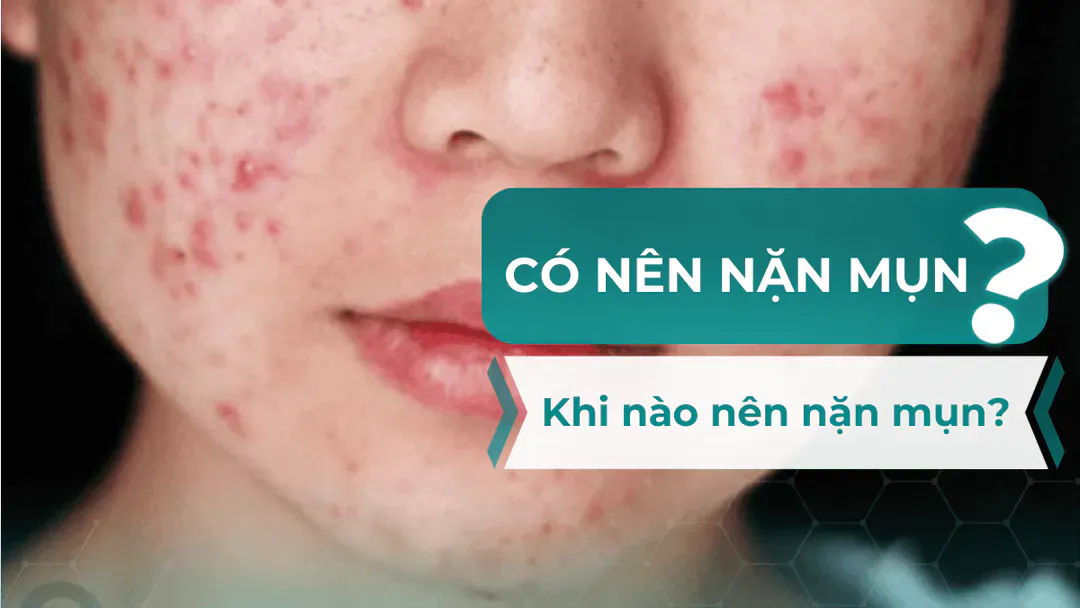 Có nên nặn mụn không? Khi nào nên nặn mụn?