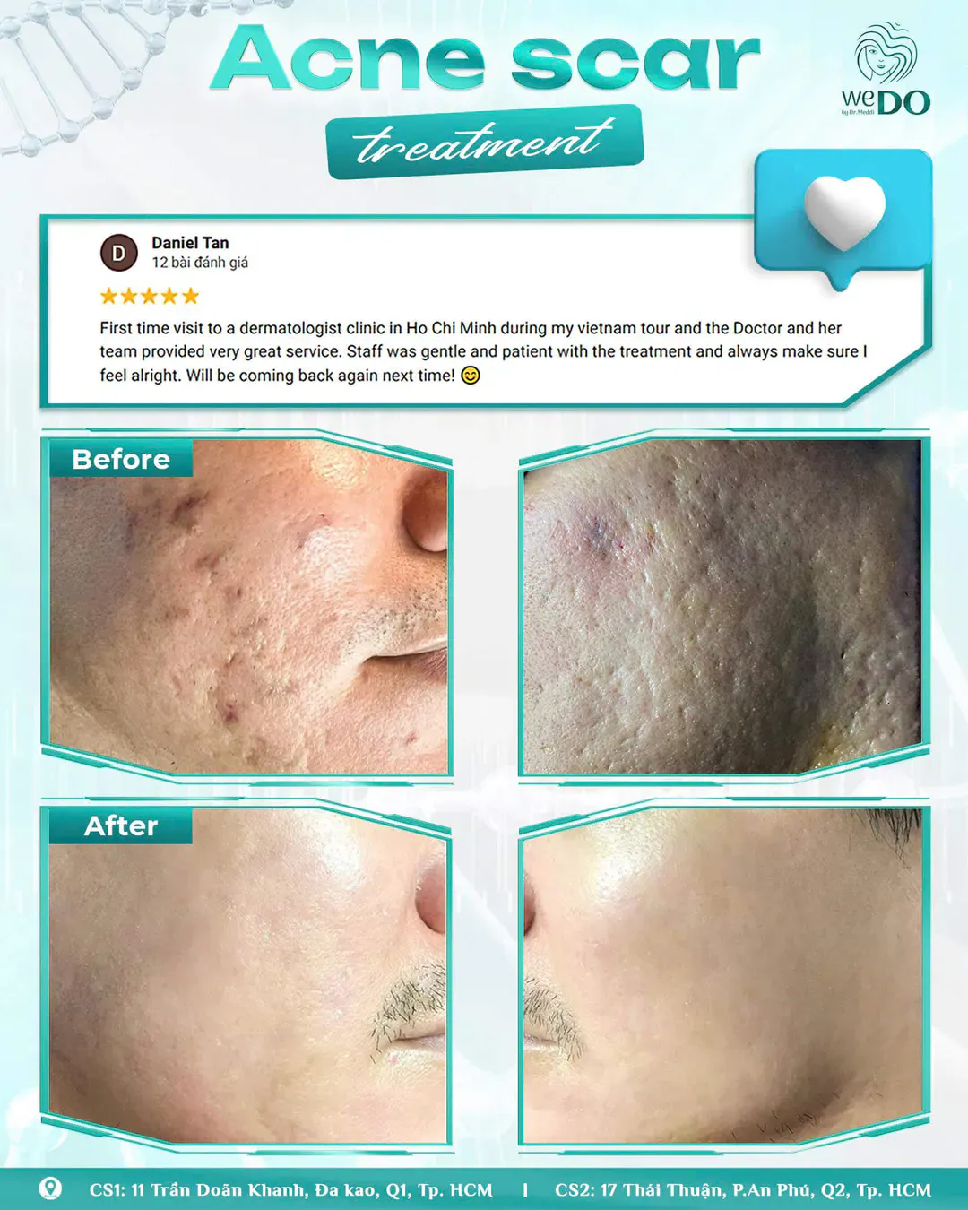 After traveling, skin suddenly became clear of acne and scars thanks to discovering the “secret” named Wedo Skin Clinic