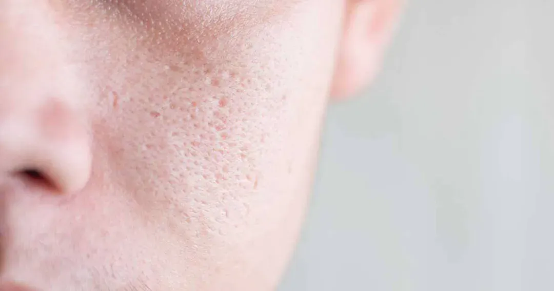 Sẹo rỗ có tự hết không? Bác sĩ da liễu giải đáp