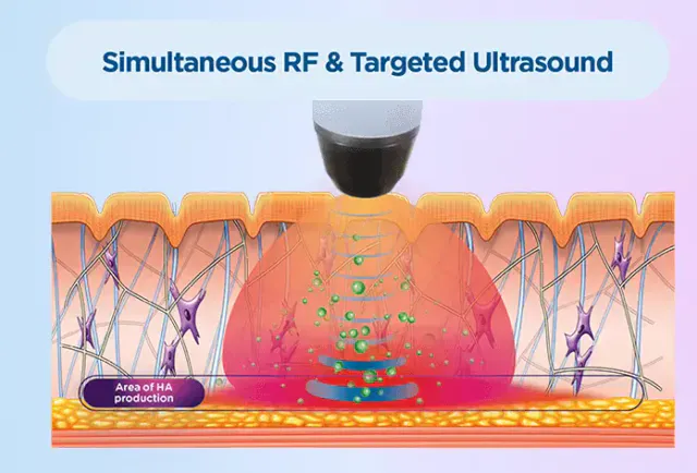 Exion Combine RF Ultrasound