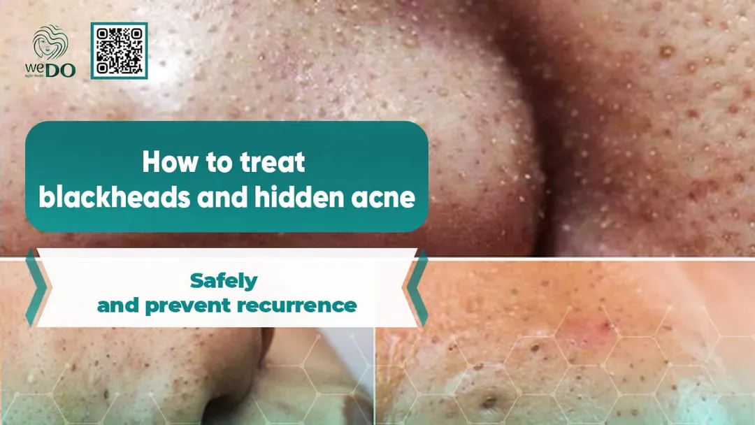 How to treat blackheads and hidden acne safely and prevent recurrence