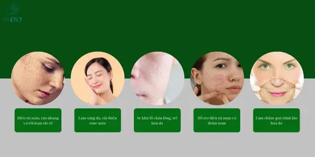 Laser toning có tác dụng chính làm mờ nám mờ tàn nhang