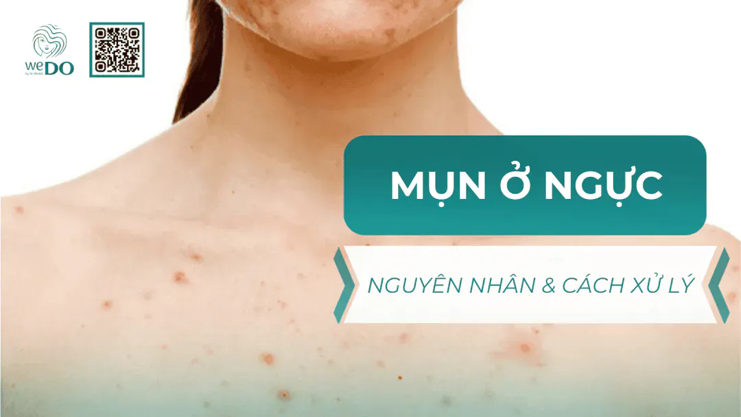 Nguyên nhân và cách xử lý mụn ở ngực